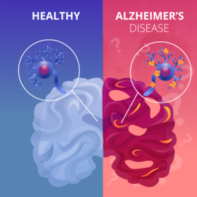 Healthy Blue Brain vs. Alzheimer Disease Red Brain
