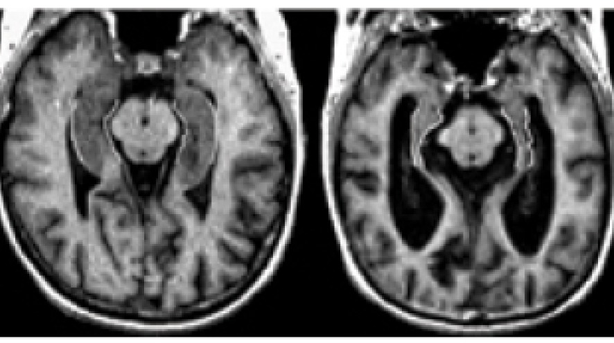 Two MRIs that depict the brain of a person without Alzheimer's, and a person with Alzheimer's.
