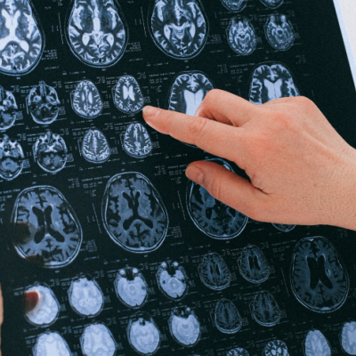 Pexel.com image of a person's hands pointing at brains on a scan